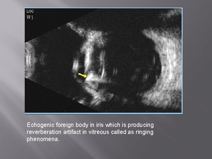 Echogenic foreign body in iris which is producing reverberation artifact in vitreous called as