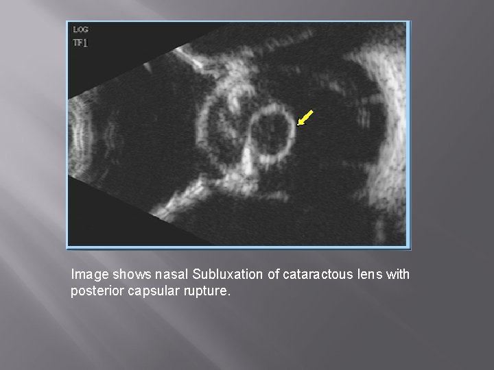 Image shows nasal Subluxation of cataractous lens with posterior capsular rupture. 