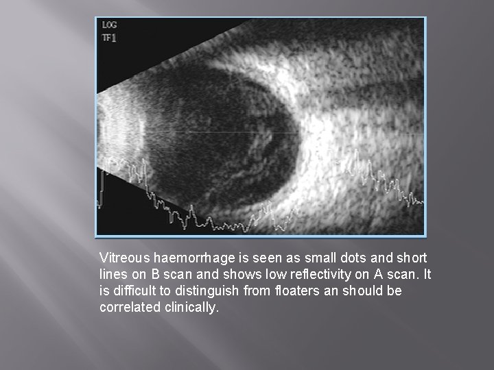 Vitreous haemorrhage is seen as small dots and short lines on B scan and