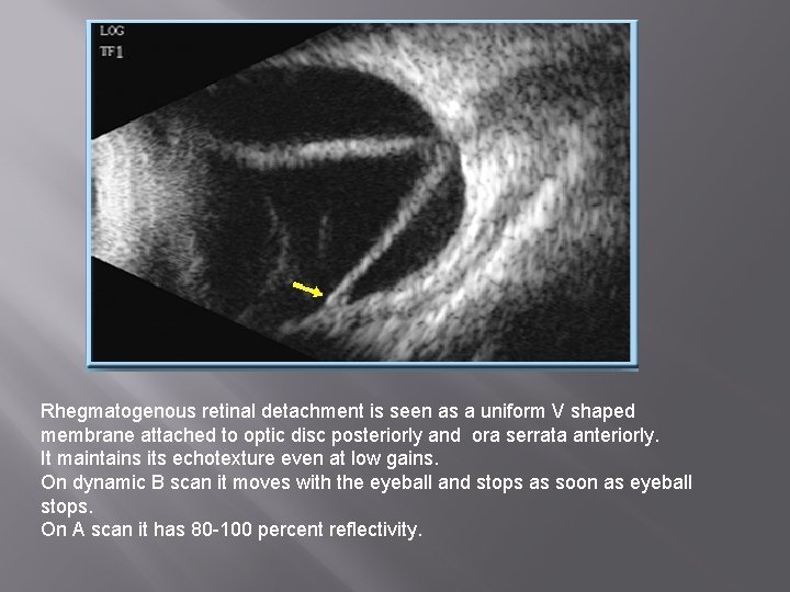 Rhegmatogenous retinal detachment is seen as a uniform V shaped membrane attached to optic