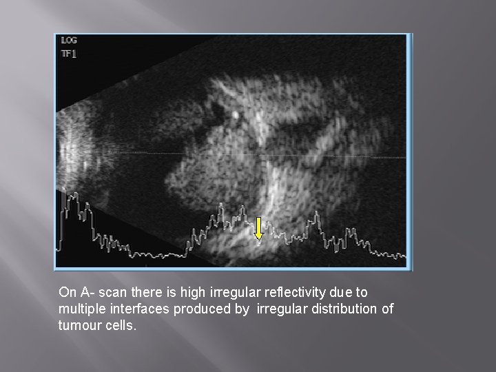 On A- scan there is high irregular reflectivity due to multiple interfaces produced by