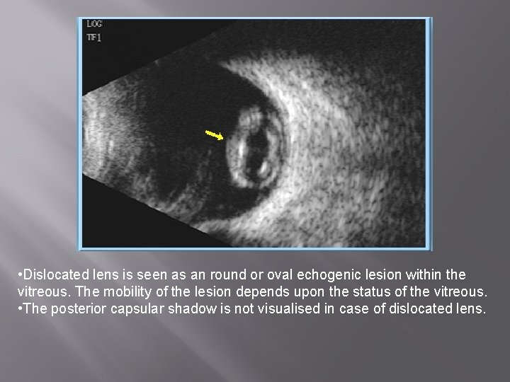  • Dislocated lens is seen as an round or oval echogenic lesion within