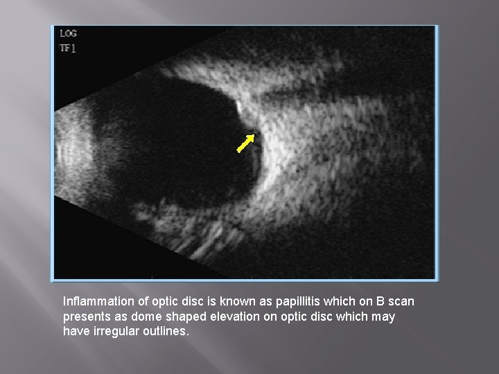 Inflammation of optic disc is known as papillitis which on B scan presents as