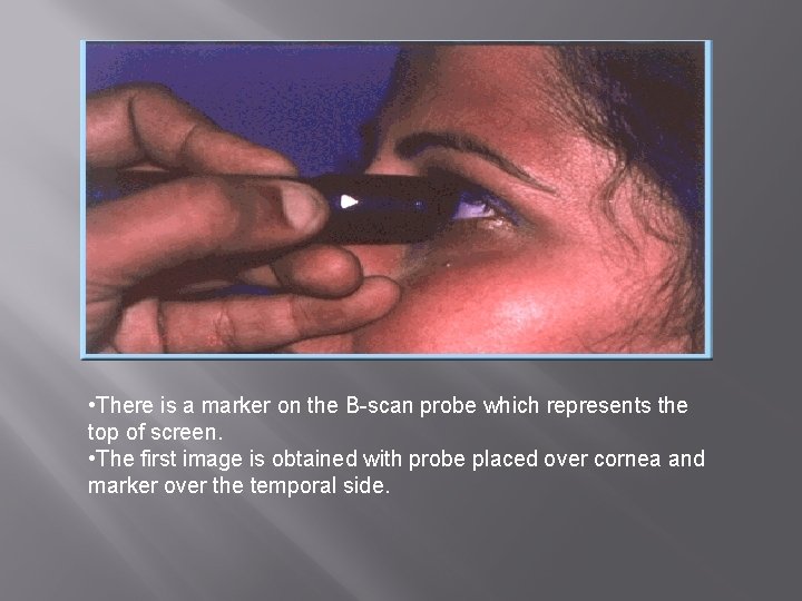  • There is a marker on the B-scan probe which represents the top