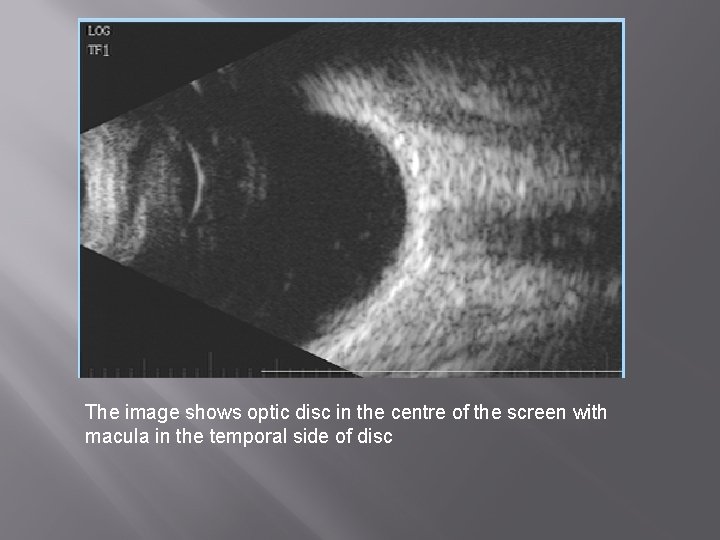 The image shows optic disc in the centre of the screen with macula in