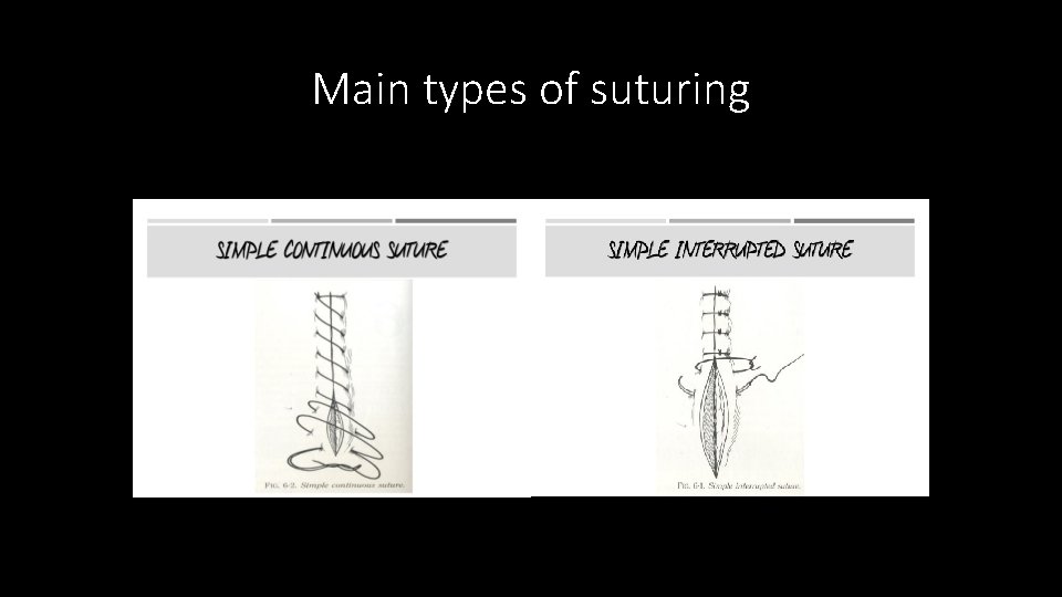 Main types of suturing 