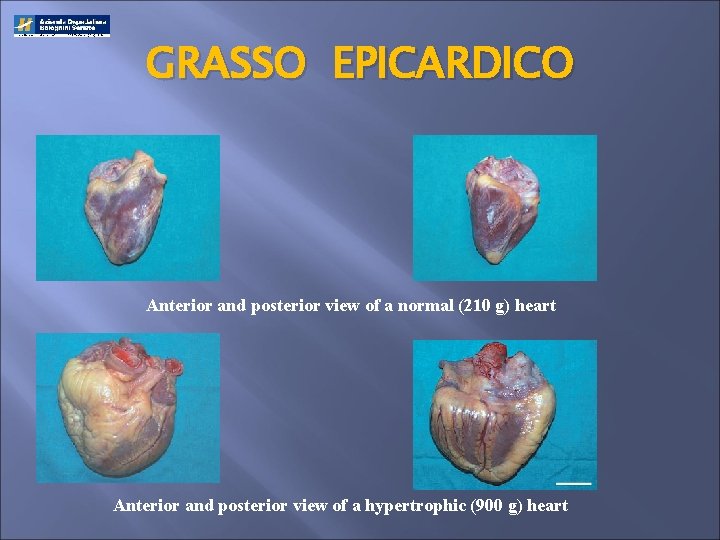 GRASSO EPICARDICO Anterior and posterior view of a normal (210 g) heart Anterior and