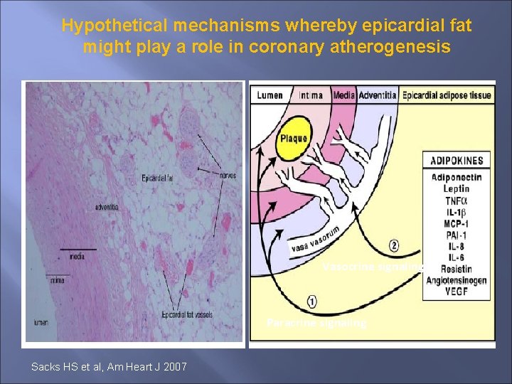 Hypothetical mechanisms whereby epicardial fat might play a role in coronary atherogenesis Vasocrine signaling