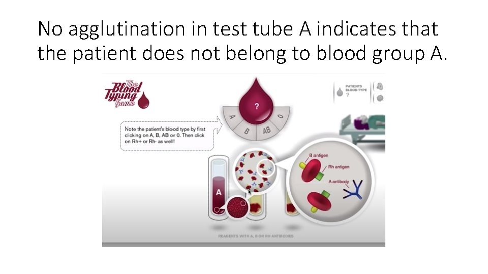 No agglutination in test tube A indicates that the patient does not belong to