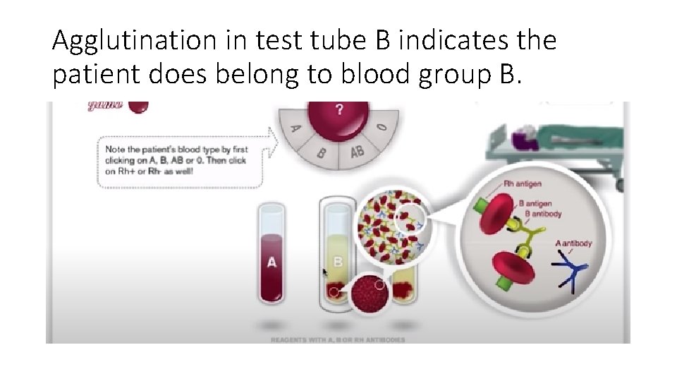 Agglutination in test tube B indicates the patient does belong to blood group B.