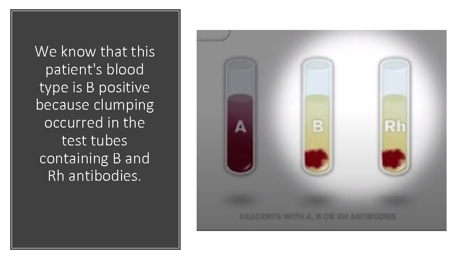 We know that this patient's blood type is B positive because clumping occurred in