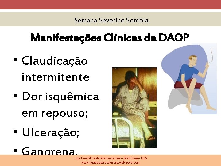 Semana Severino Sombra Manifestações Clínicas da DAOP • Claudicação intermitente • Dor isquêmica em