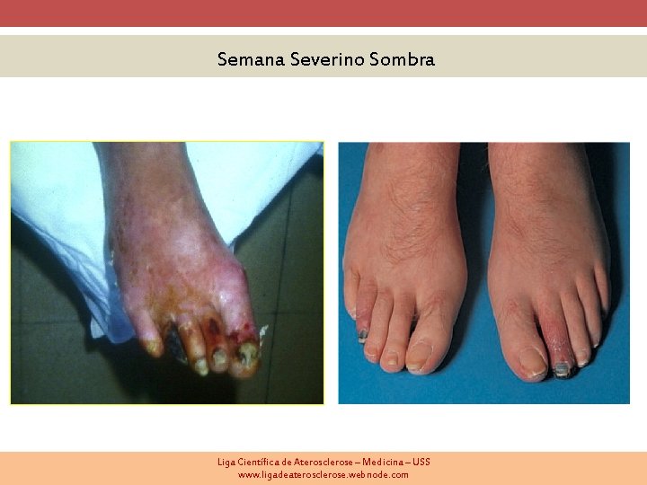 Semana Severino Sombra Liga Científica de Aterosclerose – Medicina – USS www. ligadeaterosclerose. webnode.