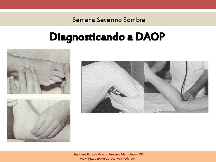 Semana Severino Sombra Diagnosticando a DAOP Liga Científica de Aterosclerose – Medicina – USS