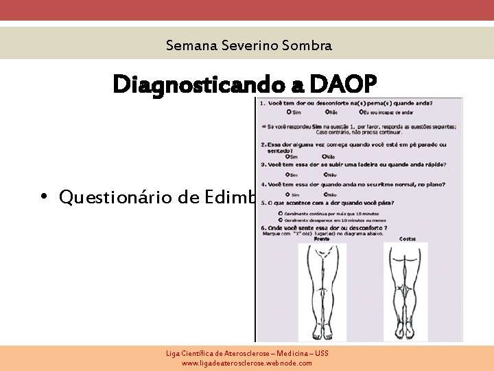 Semana Severino Sombra Diagnosticando a DAOP • Questionário de Edimburgo Liga Científica de Aterosclerose