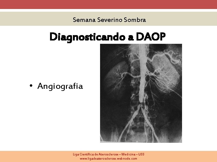 Semana Severino Sombra Diagnosticando a DAOP • Angiografia Liga Científica de Aterosclerose – Medicina