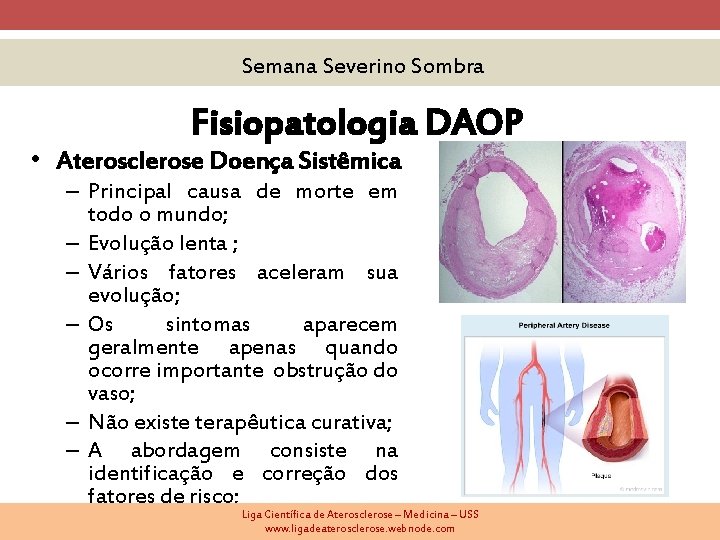 Semana Severino Sombra Fisiopatologia DAOP • Aterosclerose Doença Sistêmica – Principal causa de morte