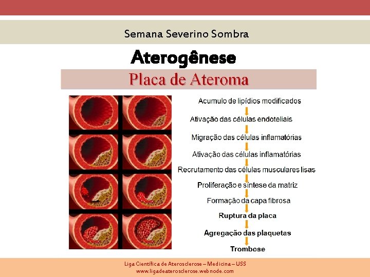 Semana Severino Sombra Aterogênese Liga Científica de Aterosclerose – Medicina – USS www. ligadeaterosclerose.