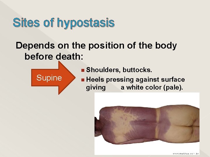 Sites of hypostasis Depends on the position of the body before death: Supine Shoulders,