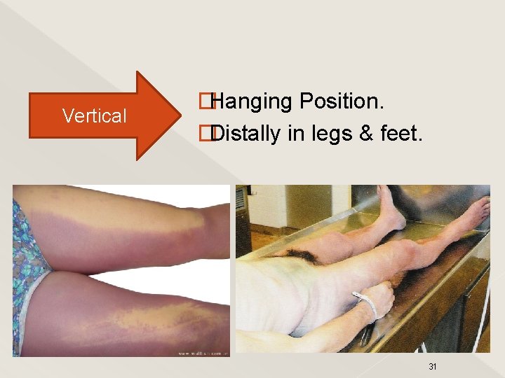 Vertical �Hanging Position. �Distally in legs & feet. 31 