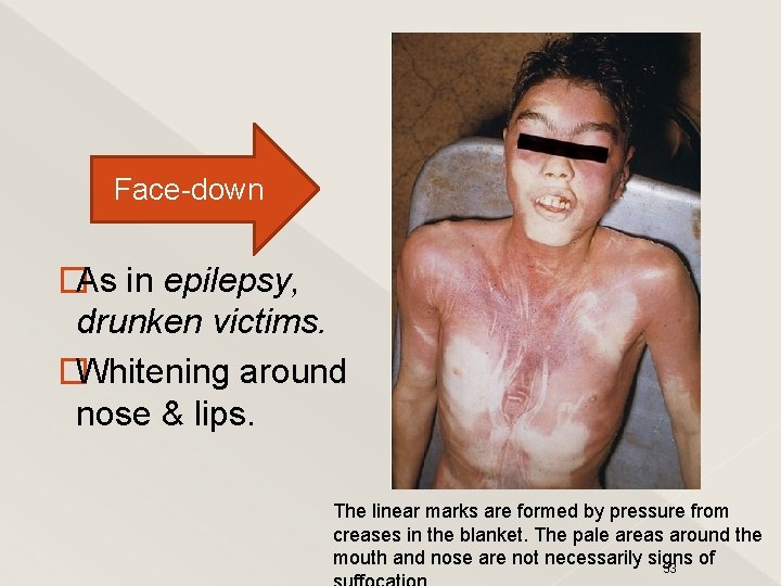 Face-down �As in epilepsy, drunken victims. �Whitening around nose & lips. The linear marks