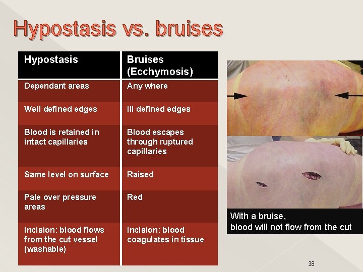 Hypostasis vs. bruises Hypostasis Bruises (Ecchymosis) Dependant areas Any where Well defined edges Ill