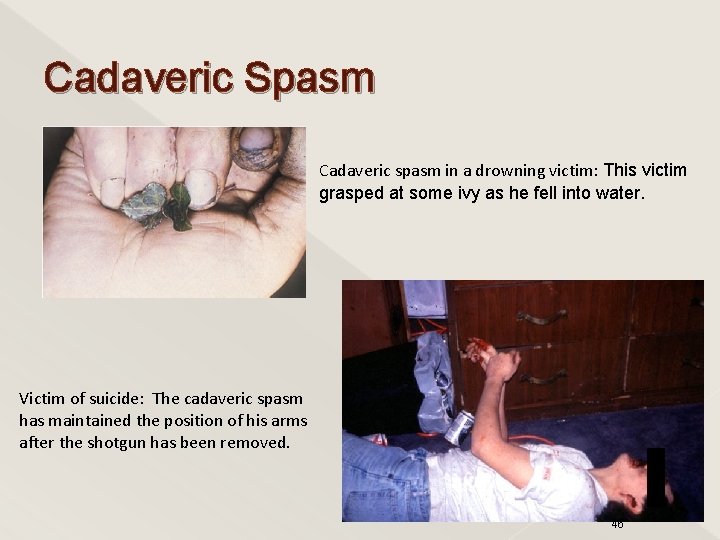 Cadaveric Spasm Cadaveric spasm in a drowning victim: This victim grasped at some ivy