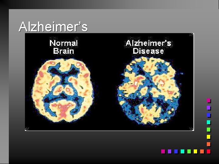 Alzheimer’s 