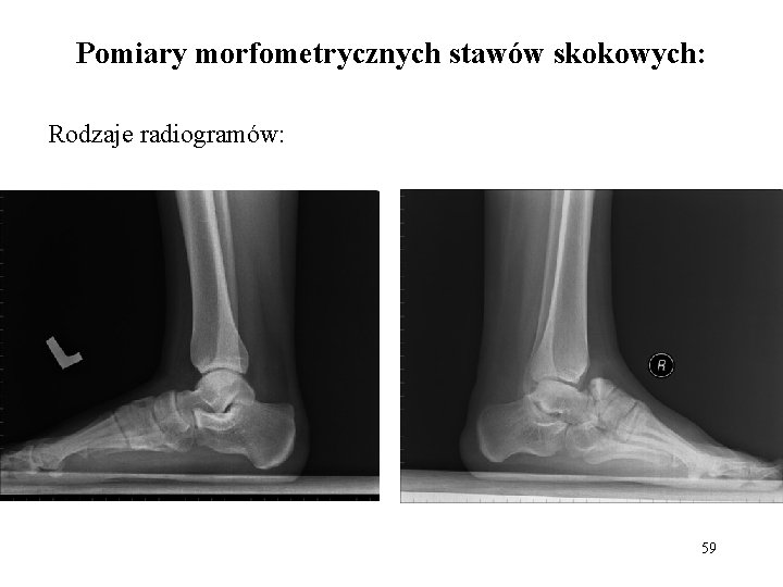 Pomiary morfometrycznych stawów skokowych: Rodzaje radiogramów: 59 