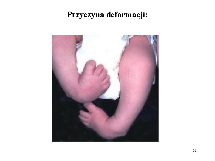 Przyczyna deformacji: 61 