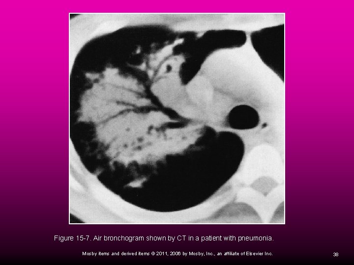 Figure 15 -7. Air bronchogram shown by CT in a patient with pneumonia. Mosby Figure 15 -7. Air bronchogram shown by CT in a patient with pneumonia. Mosby