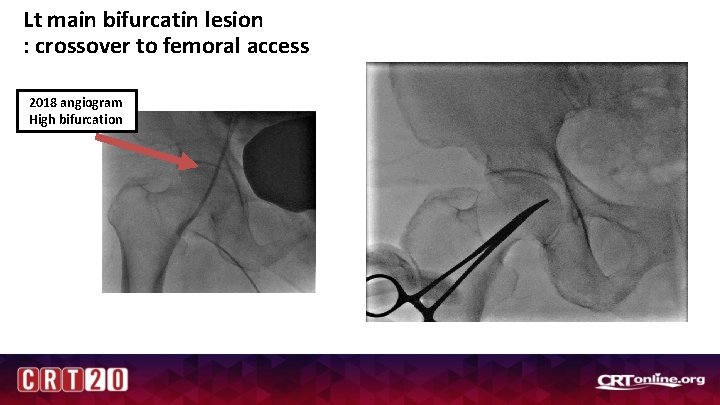 Lt main bifurcatin lesion : crossover to femoral access 2018 angiogram High bifurcation 