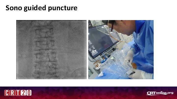 Sono guided puncture 