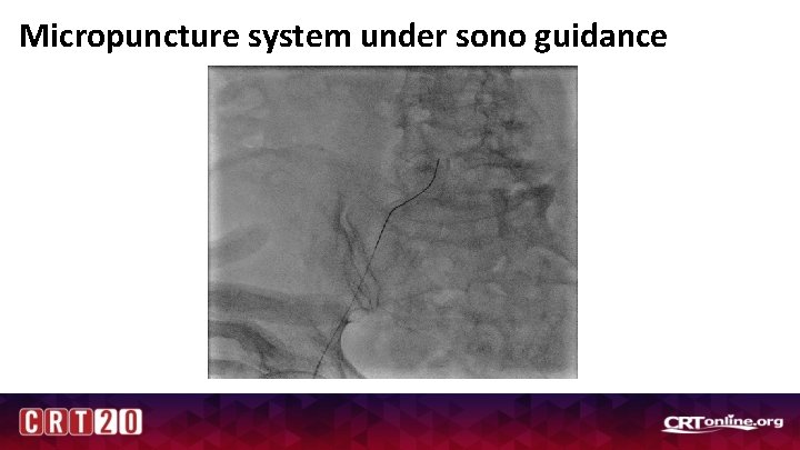Micropuncture system under sono guidance 
