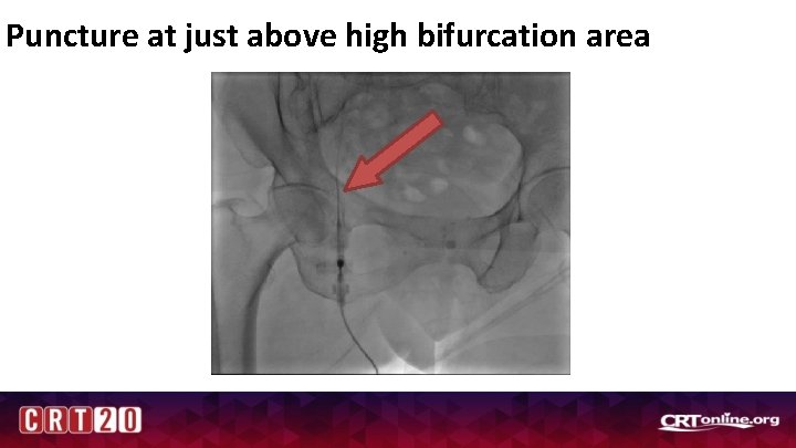 Puncture at just above high bifurcation area 