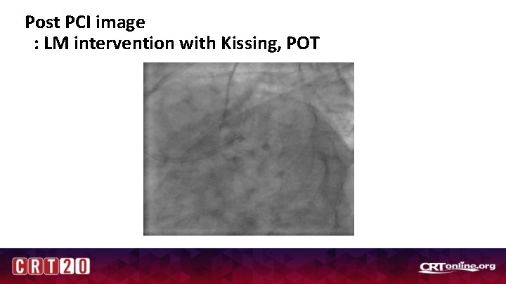 Post PCI image : LM intervention with Kissing, POT 