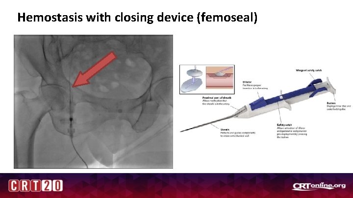 Hemostasis with closing device (femoseal) 
