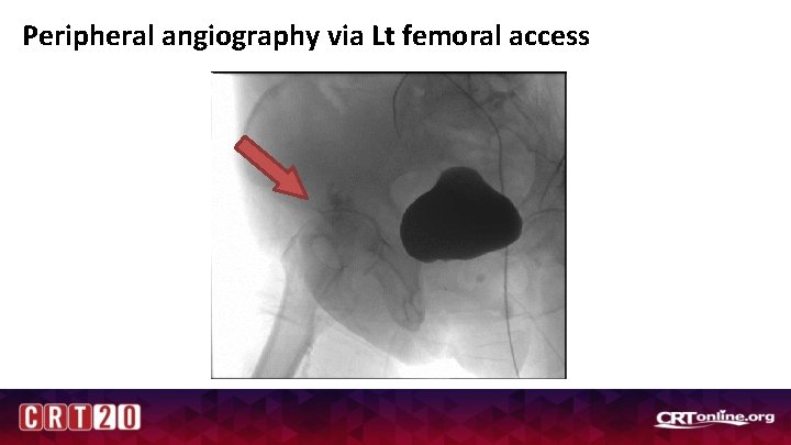 Peripheral angiography via Lt femoral access 