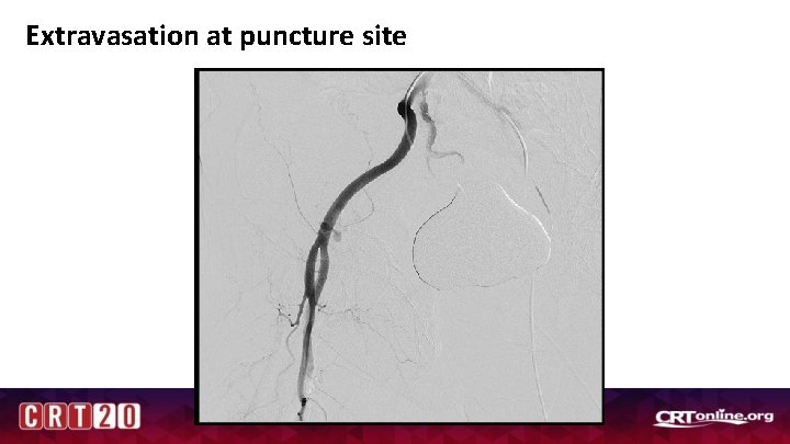 Extravasation at puncture site 