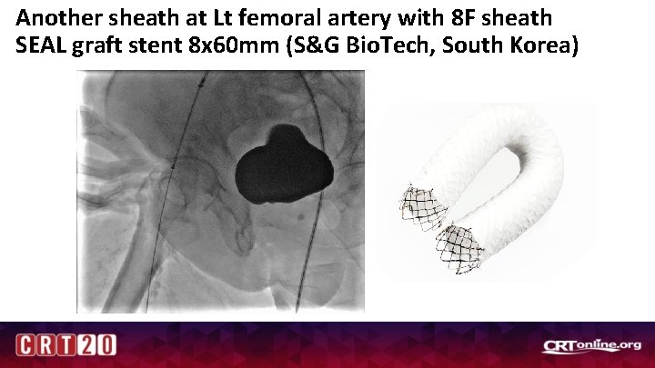 Another sheath at Lt femoral artery with 8 F sheath SEAL graft stent 8
