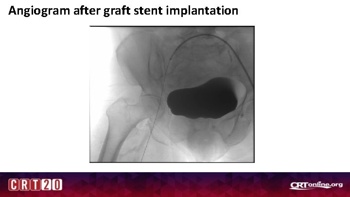 Angiogram after graft stent implantation 