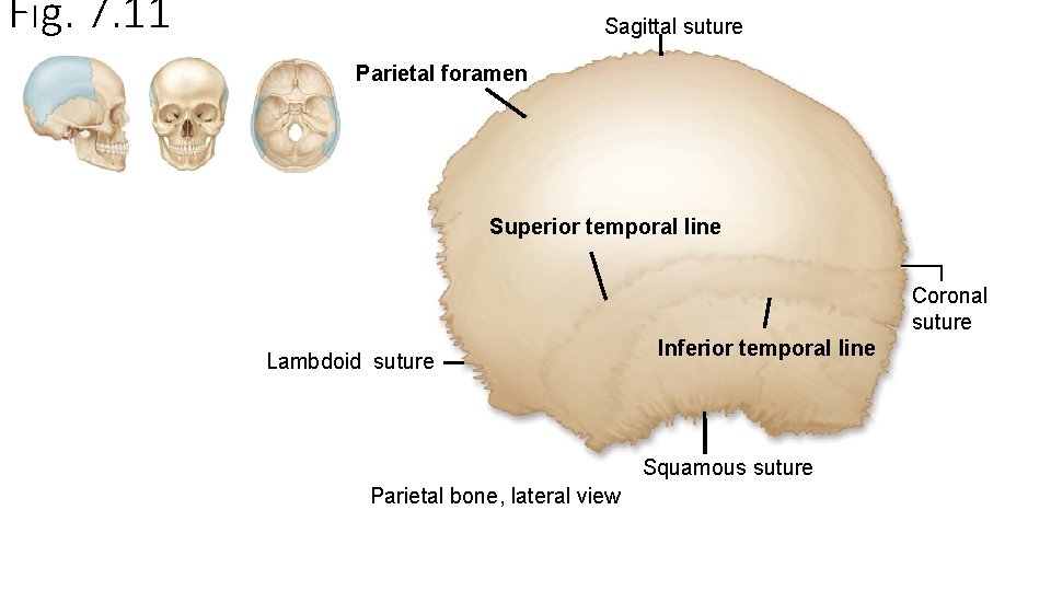 Fig. 7. 11 Sagittal suture Parietal foramen Superior temporal line Coronal suture Lambdoid suture