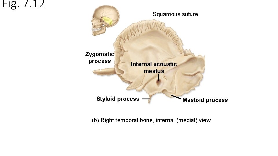 Fig. 7. 12 Squamous suture Zygomatic process Internal acoustic meatus Styloid process Mastoid process