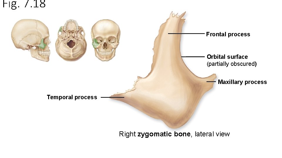 Fig. 7. 18 Frontal process Orbital surface (partially obscured) Maxillary process Temporal process Right
