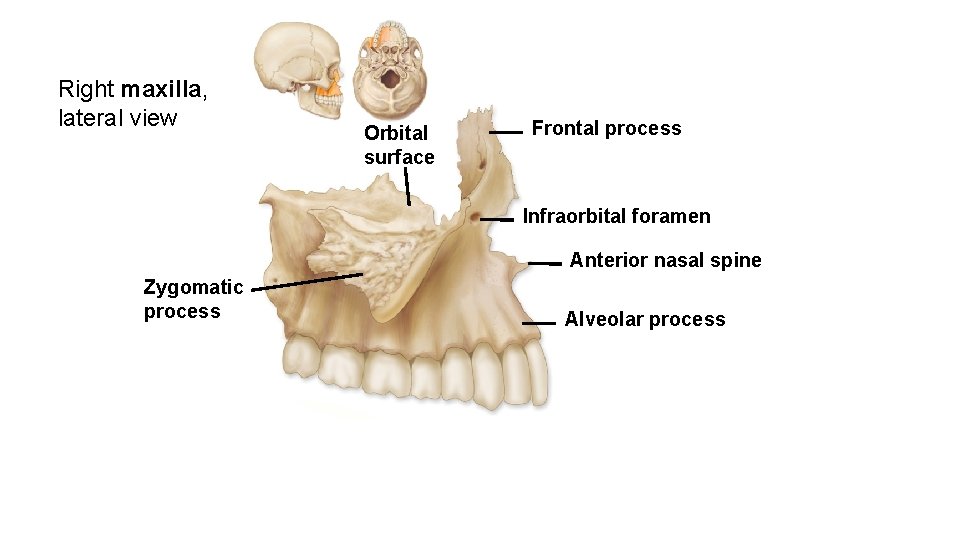 Right maxilla, lateral view Orbital surface Frontal process Infraorbital foramen Anterior nasal spine Zygomatic