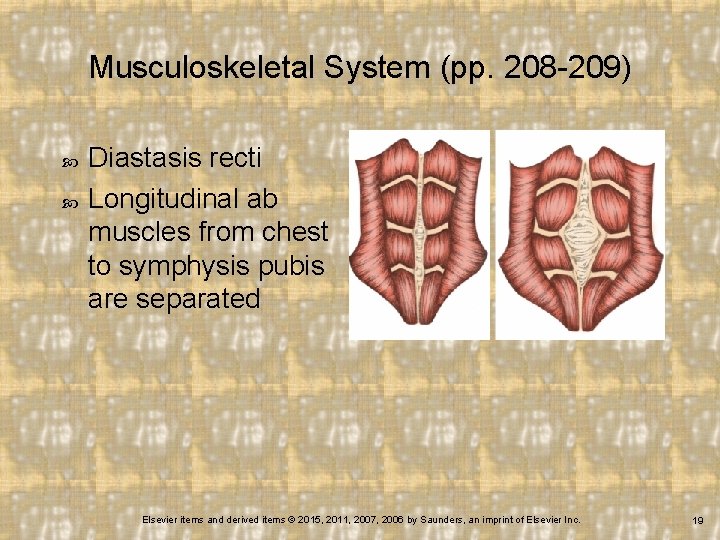 Musculoskeletal System (pp. 208 -209) Diastasis recti Longitudinal ab muscles from chest to symphysis