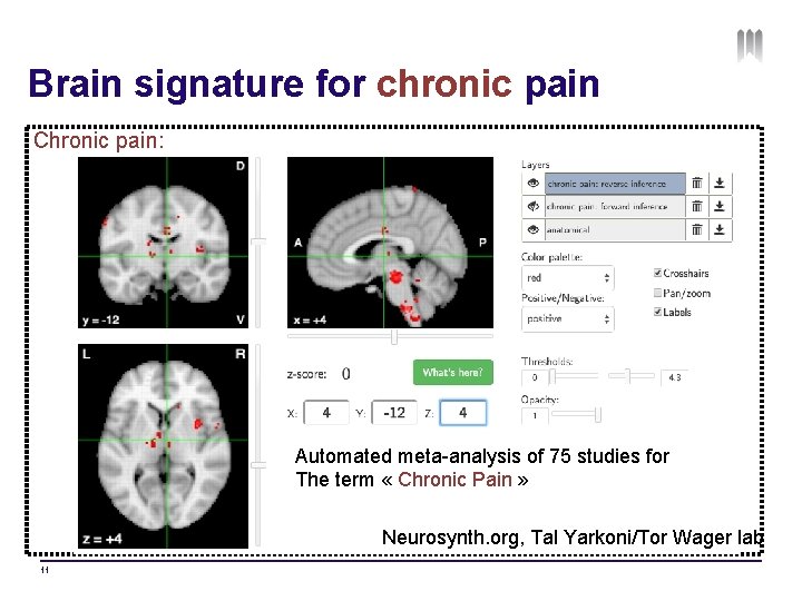 Brain signature for chronic pain Chronic pain: Automated meta-analysis of 75 studies for The