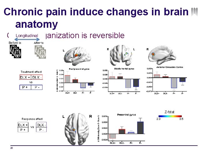 Chronic pain induce changes in brain anatomy GMD reorganization is reversible Treatment effect VS