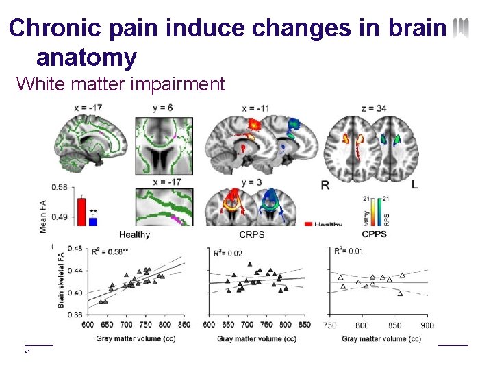 Chronic pain induce changes in brain anatomy White matter impairment 21 