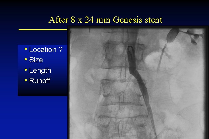 After 8 x 24 mm Genesis stent • Location ? • Size • Length